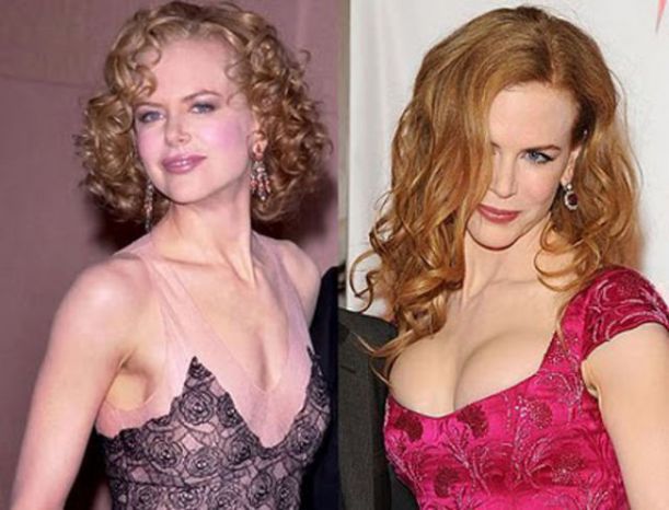 celebs_with_plastic_surgery_640_28