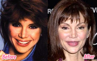 Victoria-Principal-plastic-surgery-facelift-before-after