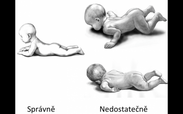 Pokud vaše děťátko zkouší &quot;pást koníky&quot; tak, jako na obrázcích vpravo, zbystřete a zajděte si raději na preventivní prohlídku k pediatrovi nebo rovnou fyzioterapeutovi.